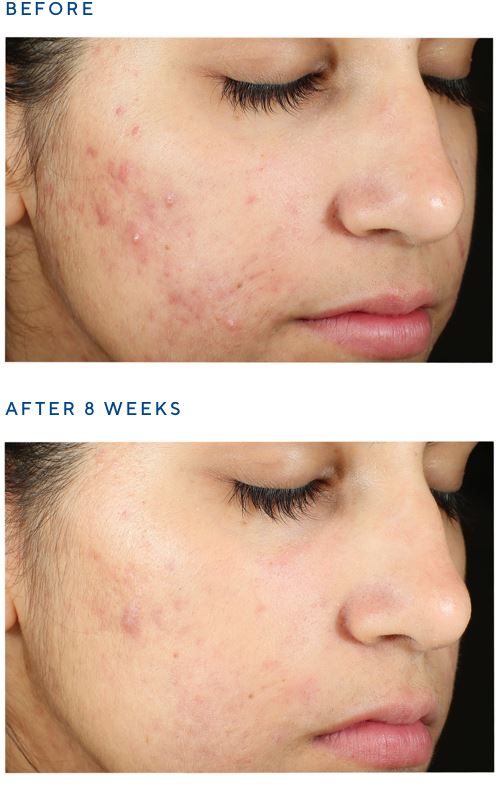 Murad Invisiscar Resurfacing Treatment 5ml (Deluxe Size)